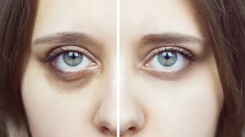 تفنيد خرافات الهالات السوداء في مشهد التجميل بدبي: توضيح المفاهيم الخاطئة الشائعة