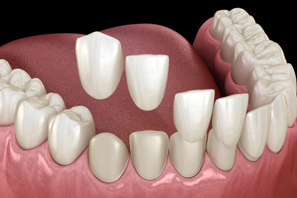 Who is not suitable for composite bonding?