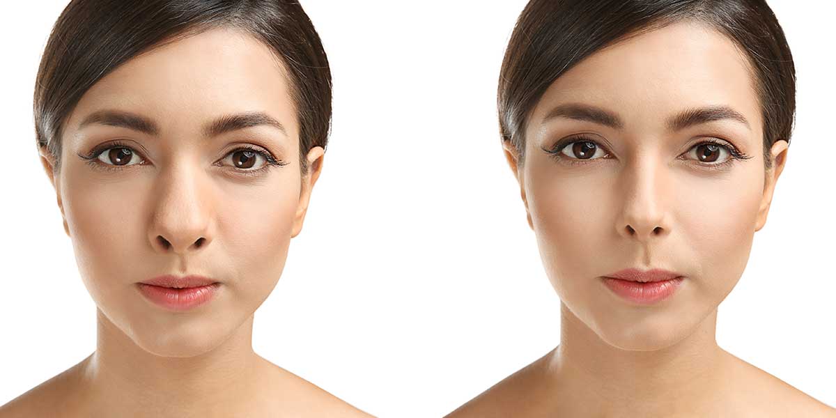 Can Rhinoplasty Correct a Saddle Nose Deformity?