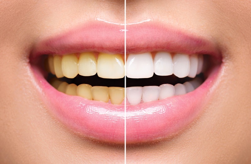 Top Causes of Yellowing Teeth and Natural Ways to Whiten Them