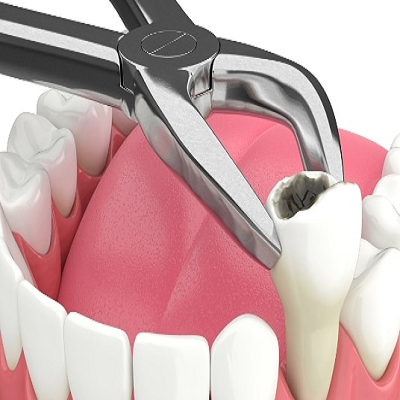 From Consultation to Extraction: Understanding Dubai’s Dental Costs