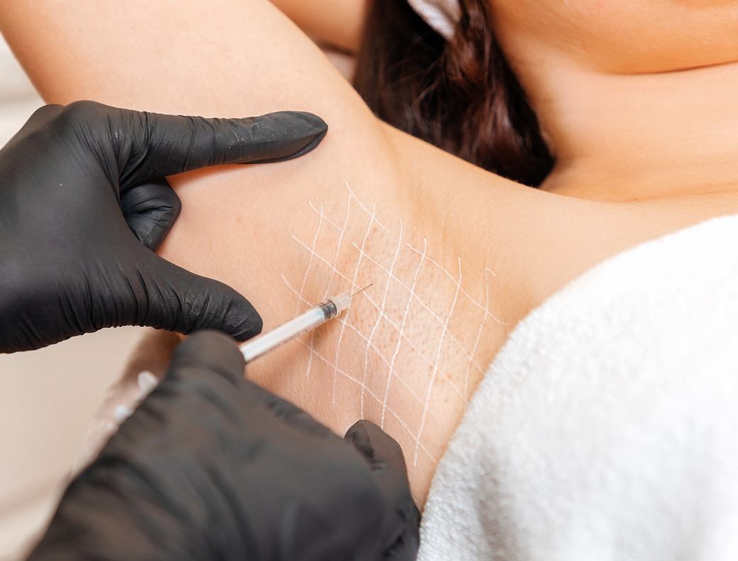 Is Botox for Sweat Glands a Safe Way to Manage Hyperhidrosis?