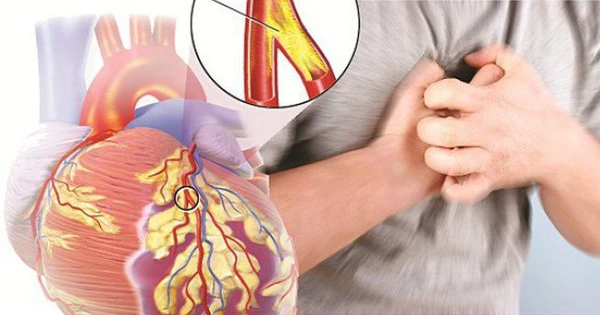 Vai trò của nitrate hữu cơ trong điều trị bệnh mạch vành