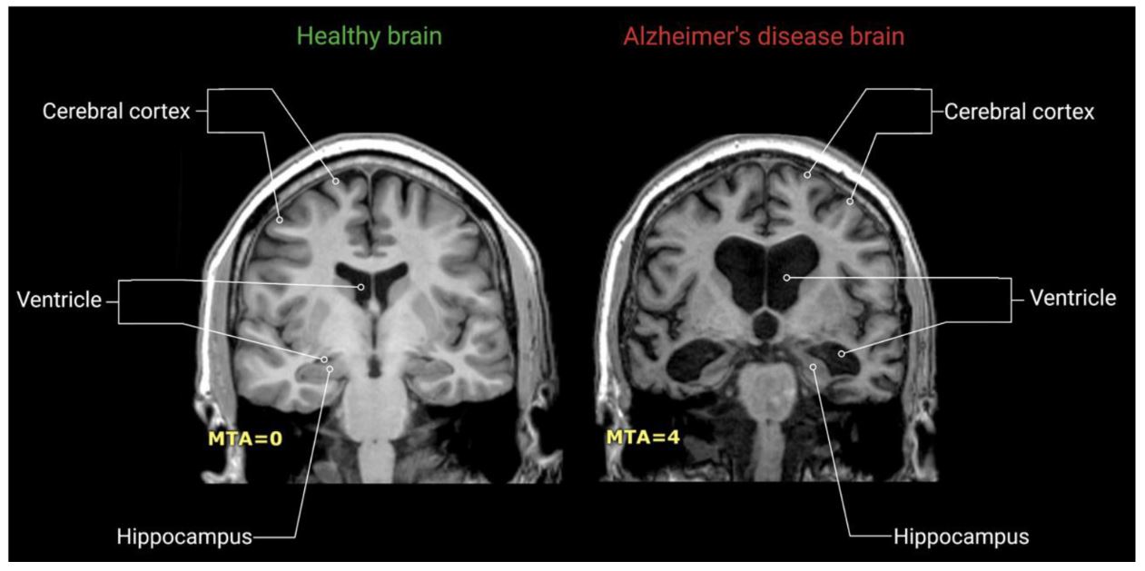 Early Diagnosis of Alzheimer’s: Advances in Biomarkers and Imaging Techniques