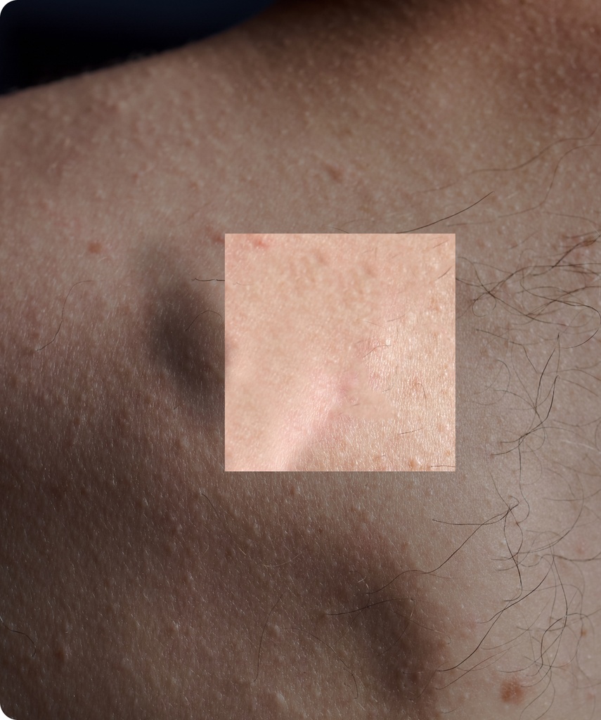 Lipoma Excision Safety and Side Effects