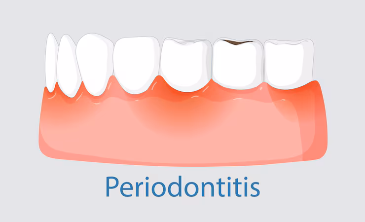 Want to Know Periodontal Treatment Costs