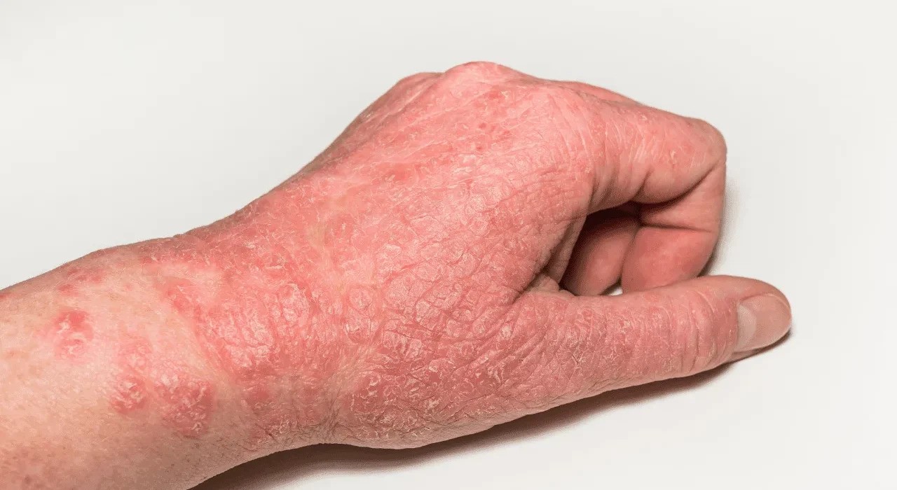 Best Homeopathic Remedies For Eczema - Rise And Shine Medical Centre