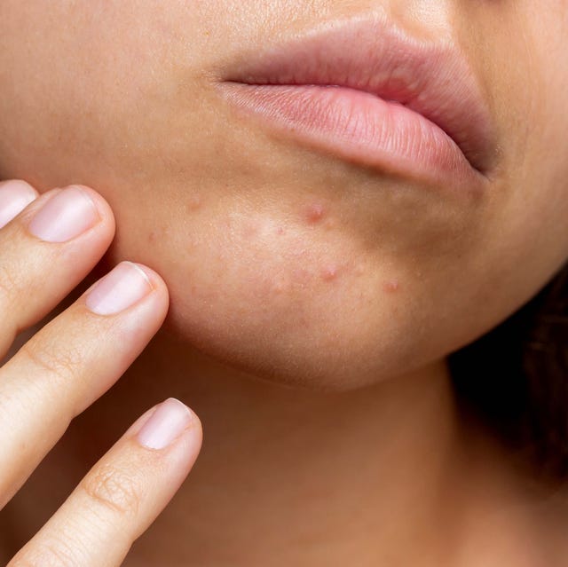 How Long Does Acne Treatment Take