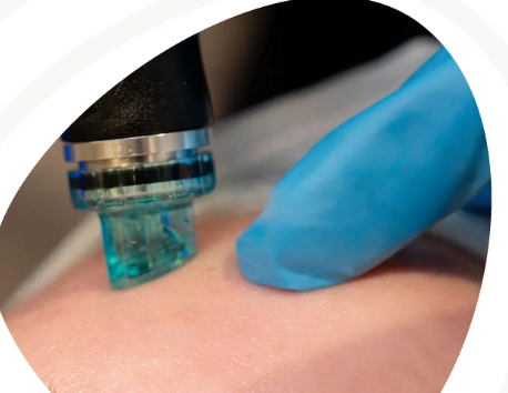 Wellness Services in London: From Dermaforce RF Microneedling to Fotona 4D Laser Lifts