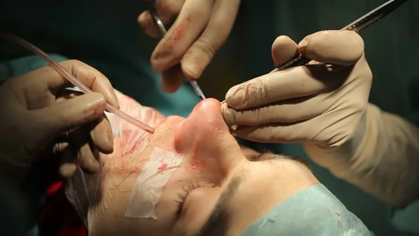 Breathing Freely Again: Understanding Turbinate Reduction and Nasal Surgery