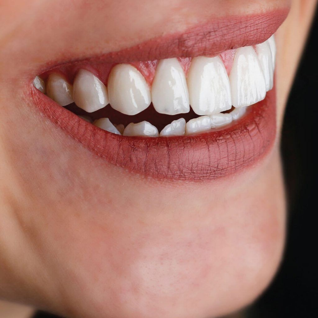 Are Composite Veneers Reversible or Permanent?