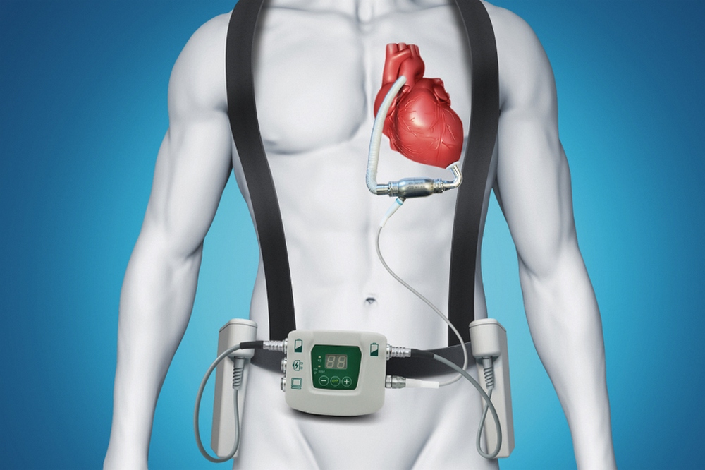 Comprehensive Overview of Cardiac Assist Devices and Their Growing Market Demand