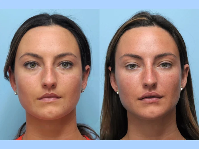 Secrets of the Best Doctors in Dubai for Thread Lift Procedures