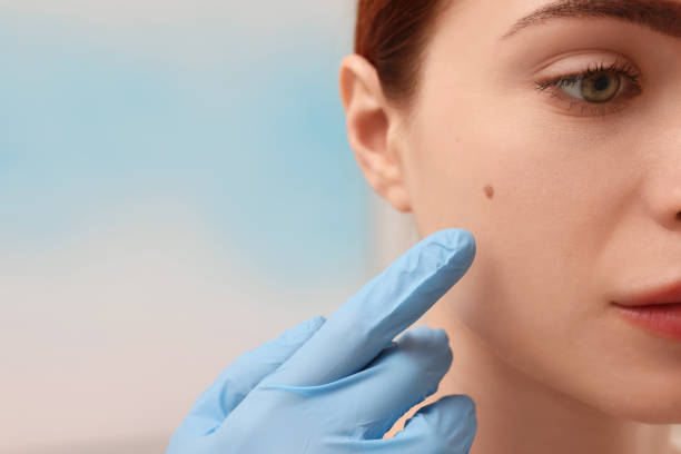 Mole Removal: How Long Does Recovery Usually Take?
