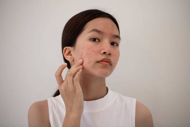 What Acne Treatment Gives Long-Lasting Results