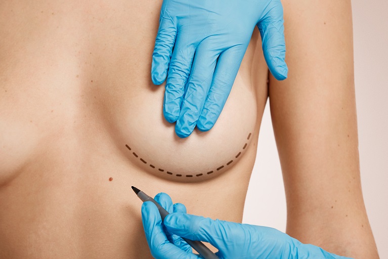 Common Myths About Breast Reduction Surgery in Riyadh Debunked