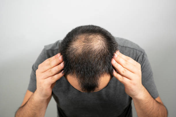 زراعة الشعر : طريقك نحو ثقة طبيعية