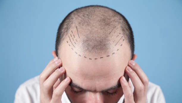 Revitalize with Hair Transplant: Hair Fall Causes and Post-Treatment Care