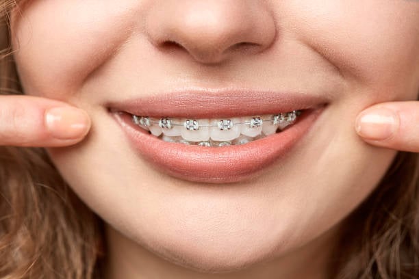 Dental Braces Cost Essentials: Financing and Longevity Advice