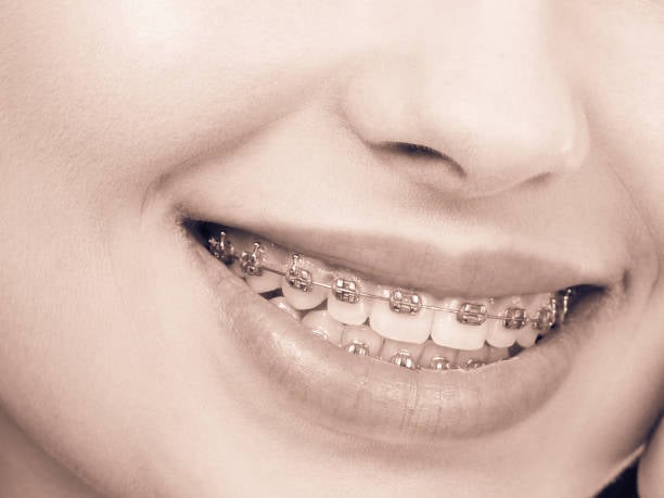 Dental Braces Cost Insights: Traditional vs. Modern Alignment Options