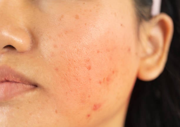 Personalizing Laser Acne Treatment Plans for Unique Skin Challenges