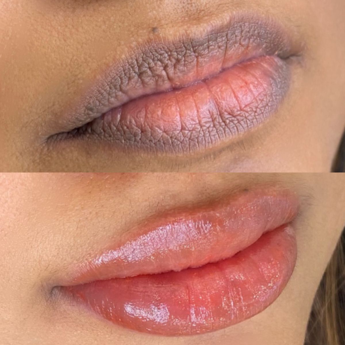Reveal Your Rosy Smile: The Ultimate Guide to the Best Lip Pigmentation Removal in Islamabad & Rawalpindi