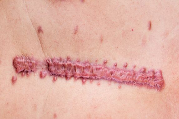 What Is the Cost of Hypertrophic Scar Treatment?