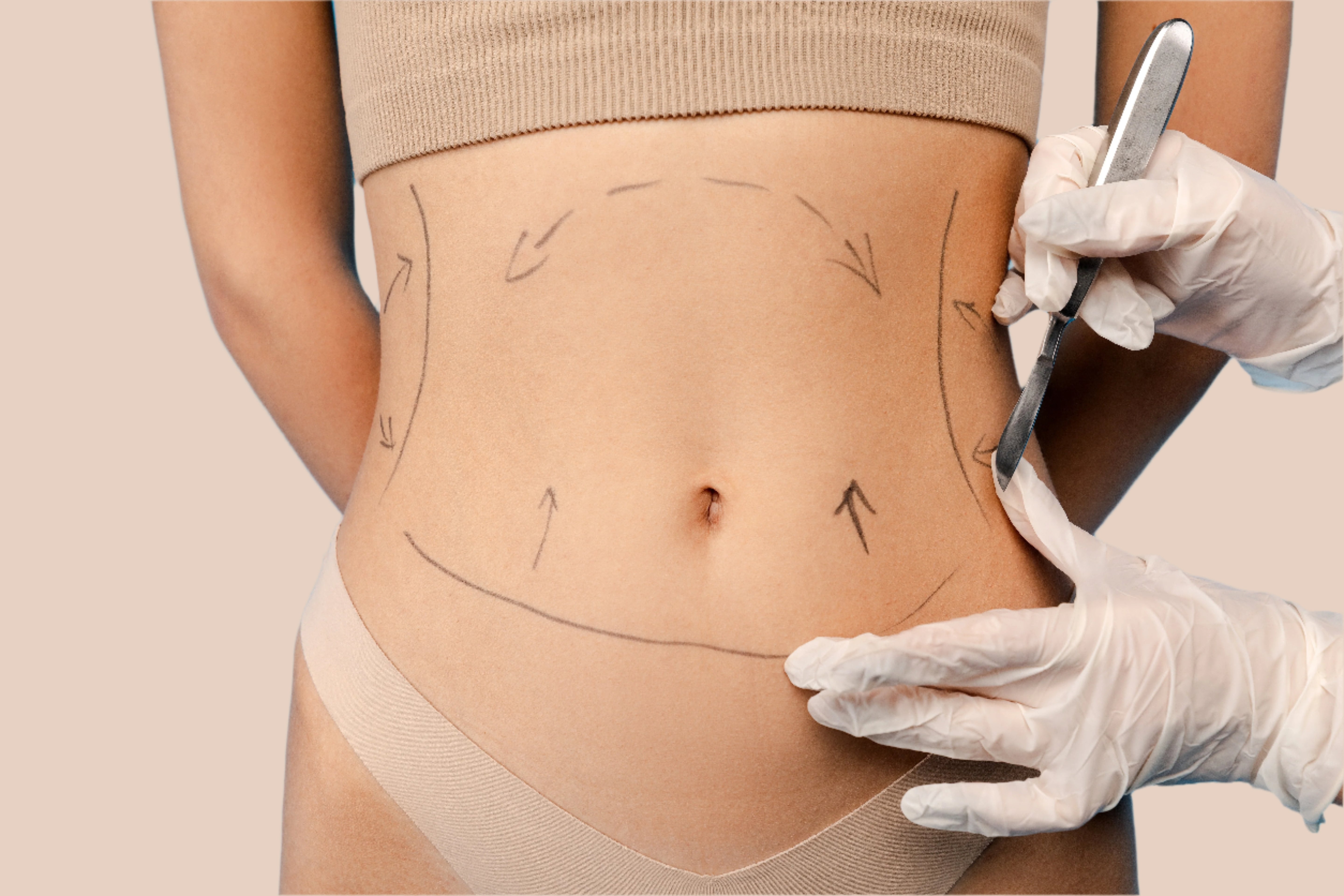 Does Lipo Abdominoplasty Remove Stubborn Fat