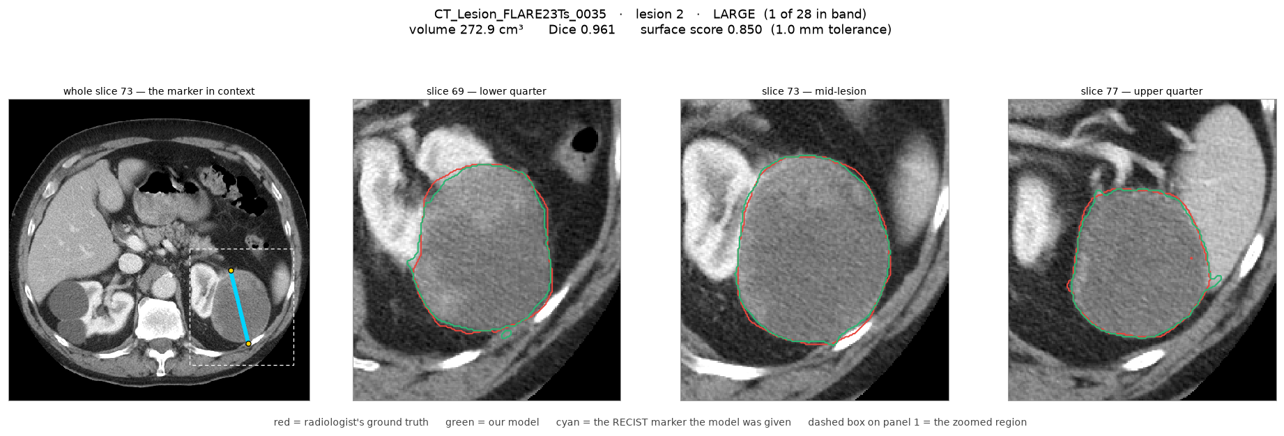 CT images of a well-circumscribed large lesion with a clear boundary; predicted segmentation closely follows the reference, with DSC 0.961 and NSD 0.850.